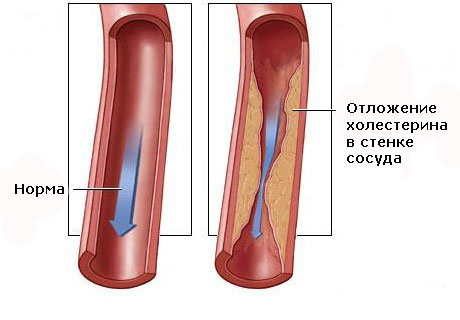 koronaro